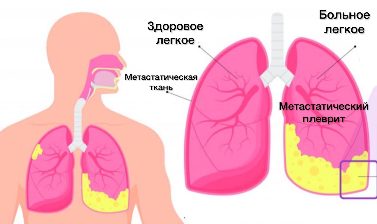 Торакоцентез – диагностика и лечение в СПб