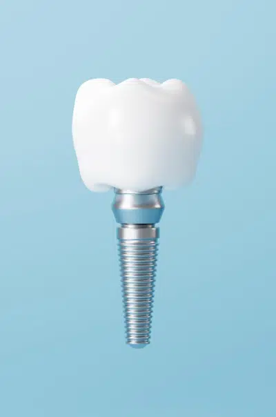 kak-pomoch-implantu-prizhitsya